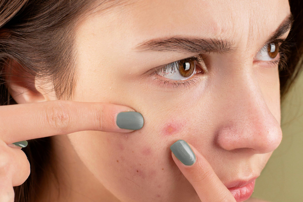 How to Take Care of Acne-Prone Skin