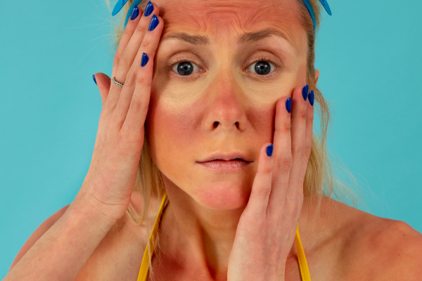 How to Care for Sunburned Skin